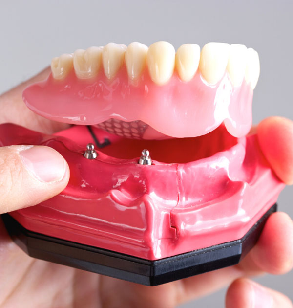 Modell eines Unterkiefers mit eingesetzten Implantaten und Zahnersatz
