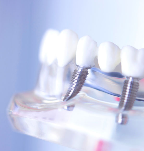 Durchsichtiges Modell des Unterkiefers mit Zähnen und eingeschraubten Implantaten